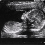 Second Trimester Ultrasound