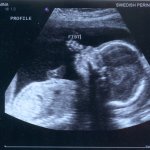 Third Ultrasound